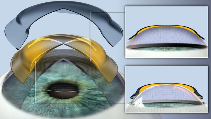 corrección de miopía mientras la persona duerme en optica zamarripa