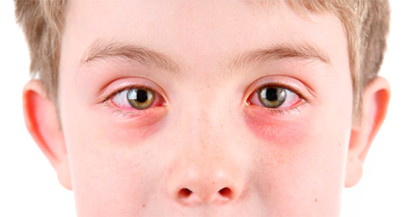 Imagen de un niño con conjuntiviitis