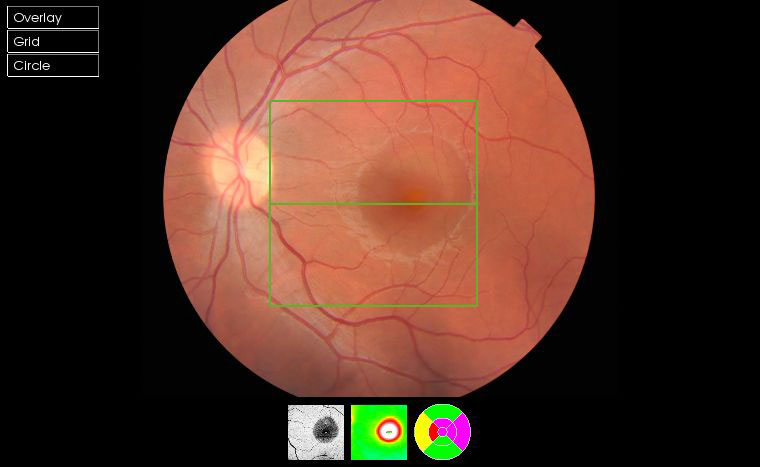 coroidopatia serosa central retina