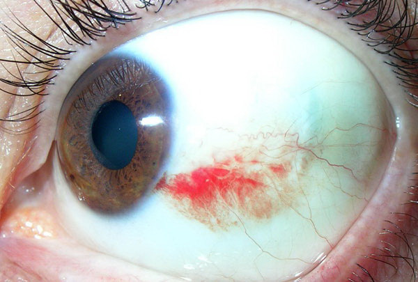 Imagen de un ojo con una hemorragia subconjuntival