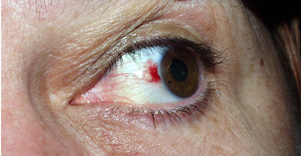 Imagen de un ojo con una hemorragia subconjuntival