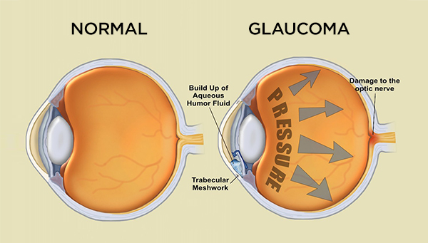 ojo normal y ojo con glaucoma