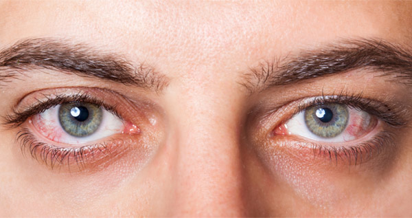 zamarripa_salud_visual_auditiva_blog_ojos_rojos