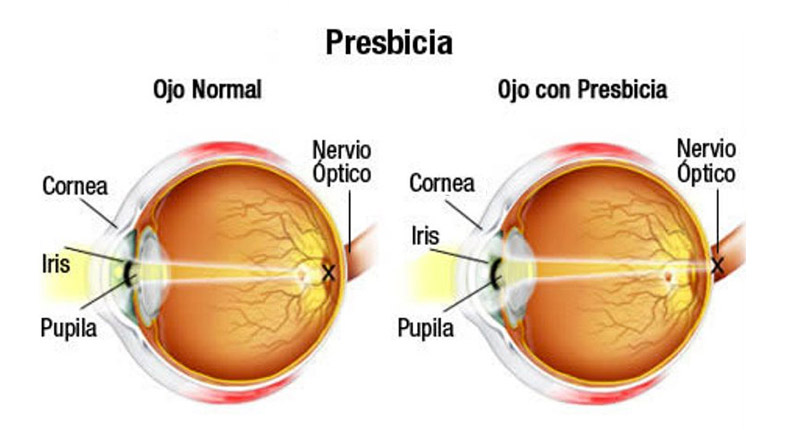 un ojo sano y otro con presbicia