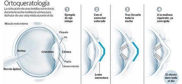 Explicación del método de la Ortoqueratología. 