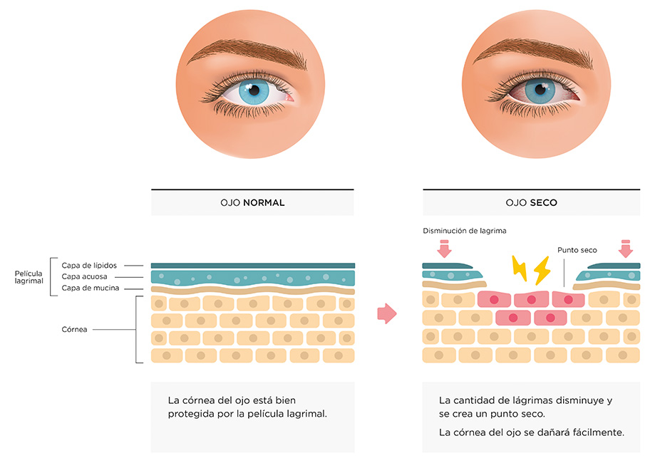 Infografía para explicar el ojo seco