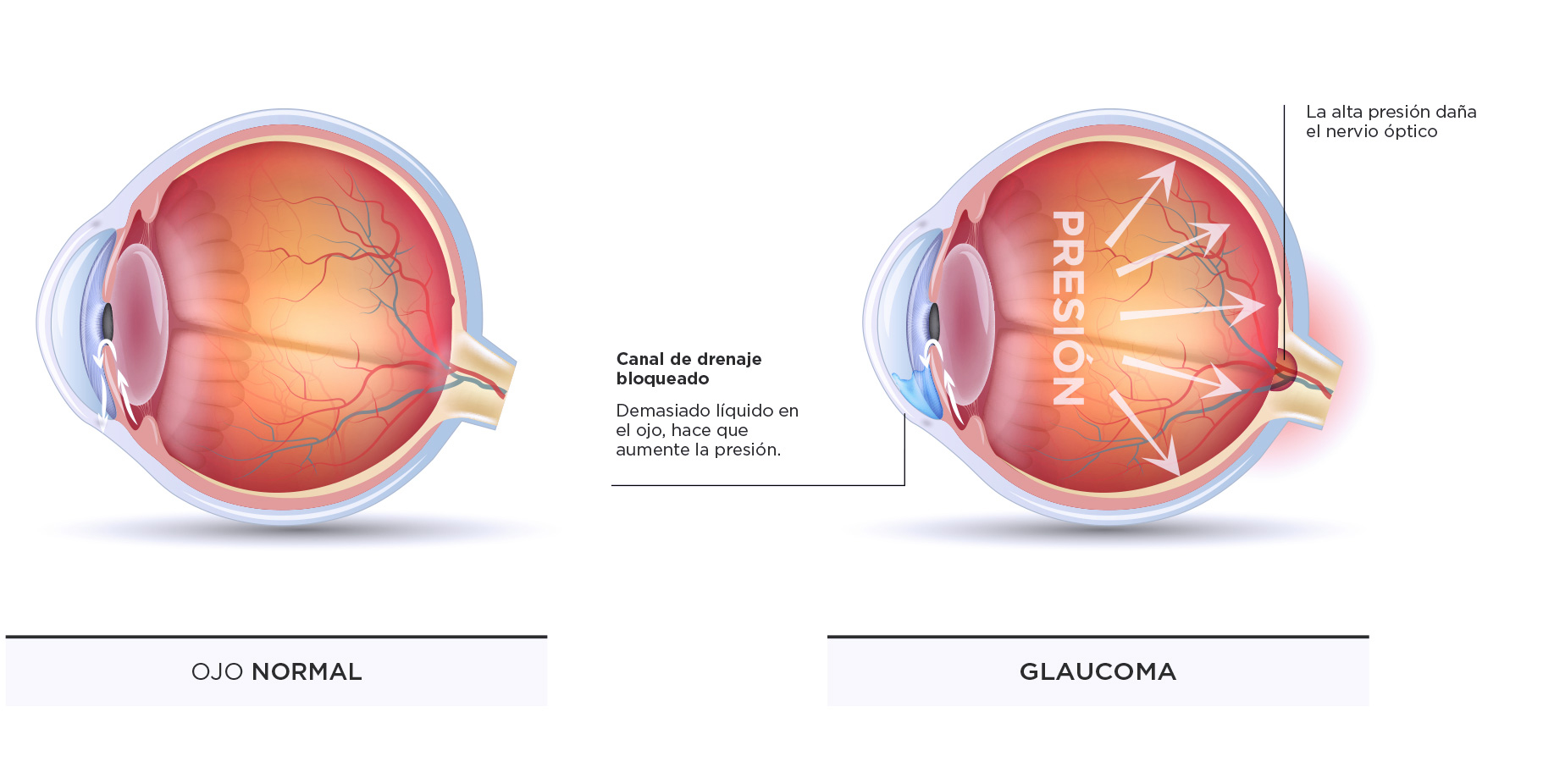 Esquema técnico que diferencia un ojo normal de un ojo con glaucoma